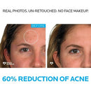 La Roche Posay Effaclar Dermatological Acne Treatment 3-Step System Kit Medicated Gel Cleanser 7.5 fl oz - Imperfect Box