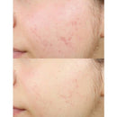 derma e Anti-Acne Oil Control Matte Moisturizer 2oz - New