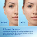 Differin Retinoid Acne Treatment; Adapalene Gel 0.1% 45g/1.6oz - Missing Box